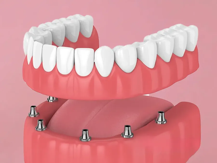 Prótese protocolo fixa sobre implantes representando arcada completa