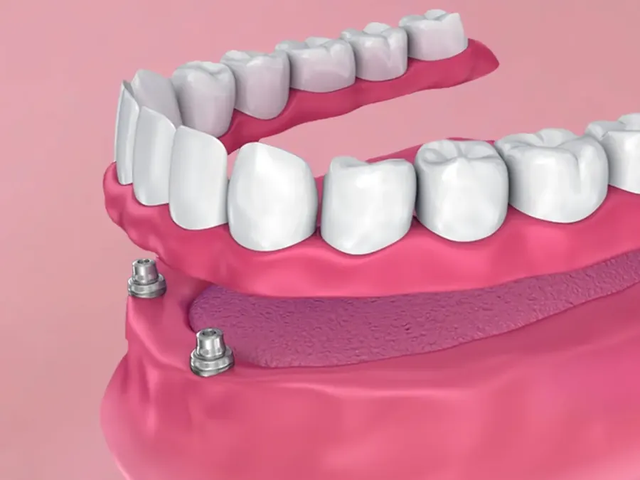 Prótese overdenture com sistema de encaixe sobre dois implantes